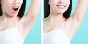 Full Body Hair Reduction