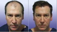 Hair Transplant surgery