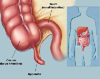 Appendix Cancer Treatment
