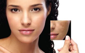 Melasma Laser Treatment