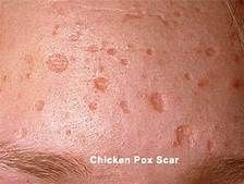 chickenpox vaccine