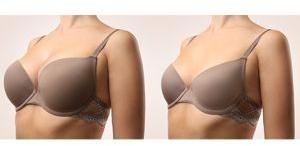 Breast Liposuction Surgery Treatment Services