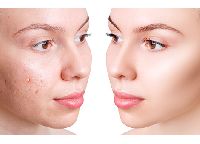 Facial Scars Treatment Services