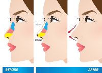 Flat Nose Surgery Treatment Services