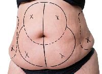 liposuction surgery services