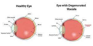 Eyes Macular Degeneration Non-Invasive Diagnosis and Therapy