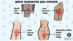 HERPES - F