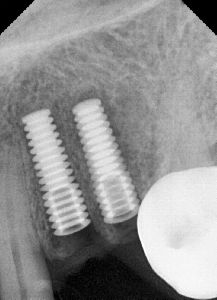 dental implant treatment
