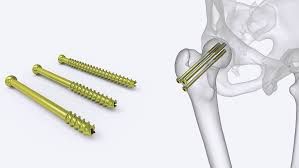 cannulated screws