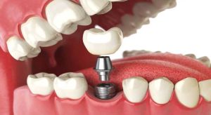 Dental Implant