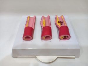 Artery Blockage Model