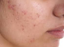 acne treatment services