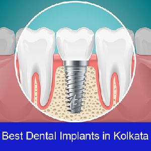 Dental Implant In Kolkata Best Dental Implant In Kolkata Dental Implant Treatment In Kolkata