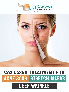 Carbon Laser Facial