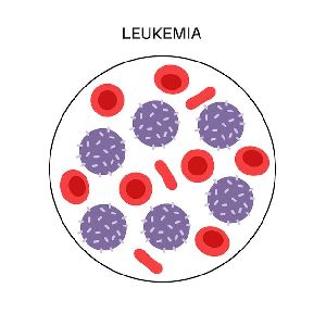 Leukemia Treatment