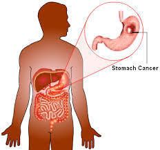 Other Stomach Related Problems Treatment