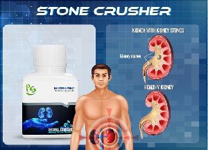 Kidney Stone Removal