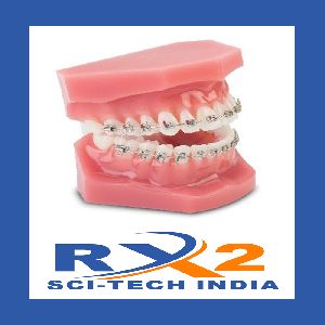 Dental Model with Braces