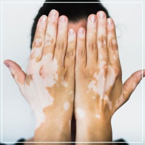 vitiligo treatment services.