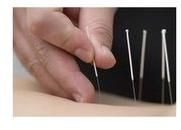 acupuncture needle