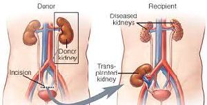 Kidney Transplant Services