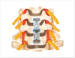 Cervical Anterior Plating System