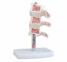 CUT AWAY OSTEOPOROSIS MODEL