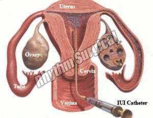 IUI Catheter