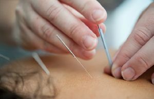 Three Edged Needle Acupuncture Services