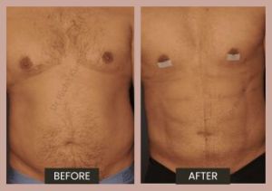 gynecomastia surgery