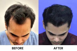 Hair Transplantation