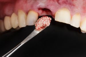 Bone Grafting Services