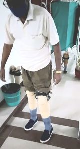 Below Knee Artificial Leg