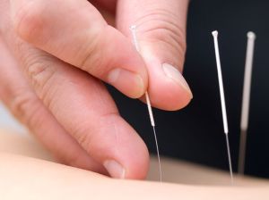 Needling Acupuncture Therapy