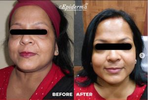 Dermal Fillers Treatment