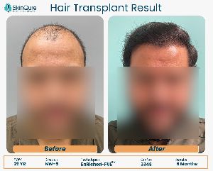 Hair Transplant Service