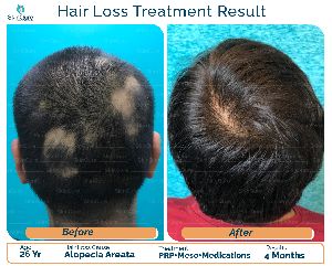 Hair Transplantation