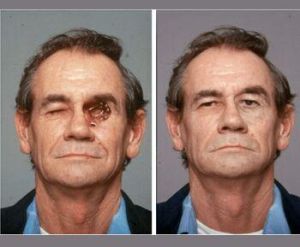 MAXILLO FACIAL PROSTHESIS