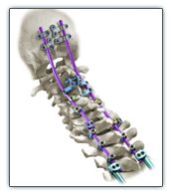 Spine Lateral Mass Polyaxial Screws