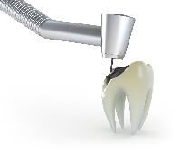 dental filling materials