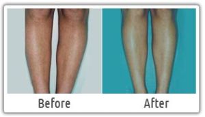 Laser Hair Removal Treatment Services