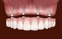 Dental Implants Bangalore