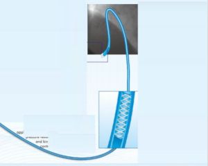 Angiography Catheter