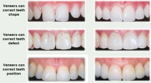 Veneers Crown and Bridges