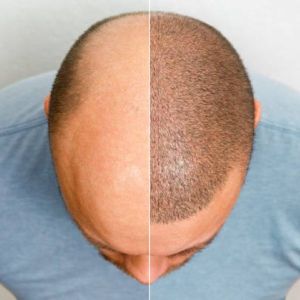 fue hair transplant service