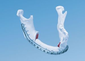 Mandible Implants