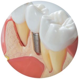 Dental Implant Treatment Services