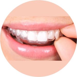 Invisible Braces Treatment Services