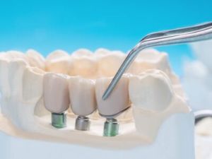 Dental Crown & Bridges Treatment Services