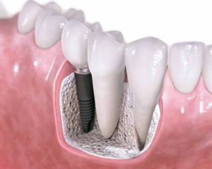 Dental Implant Surgery Service